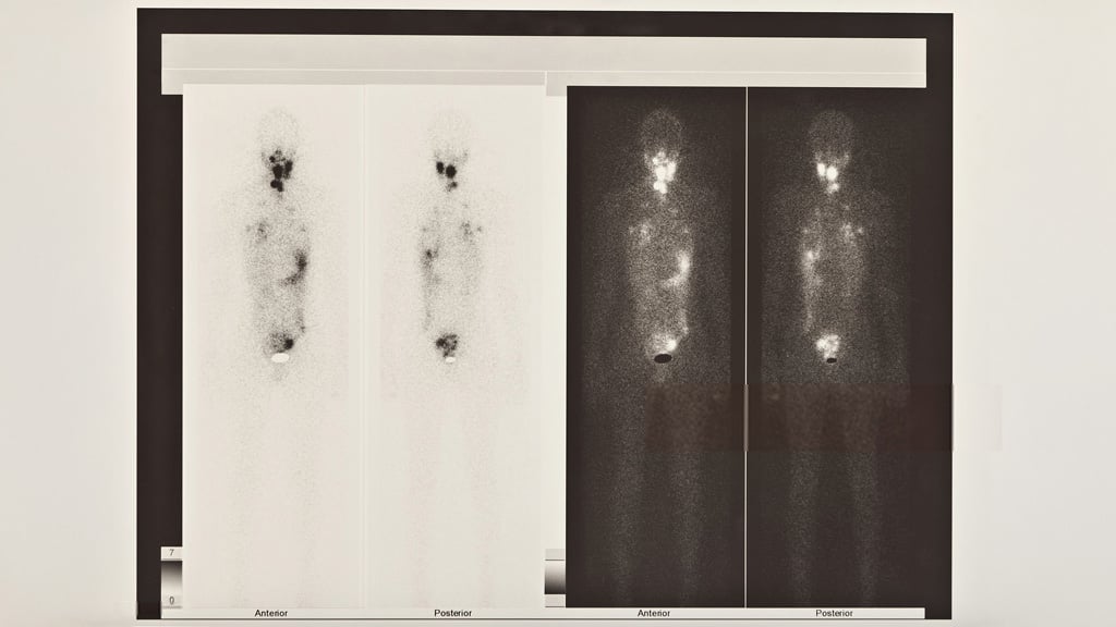 Whole-body SPECT scan showing anterior and posterior views.